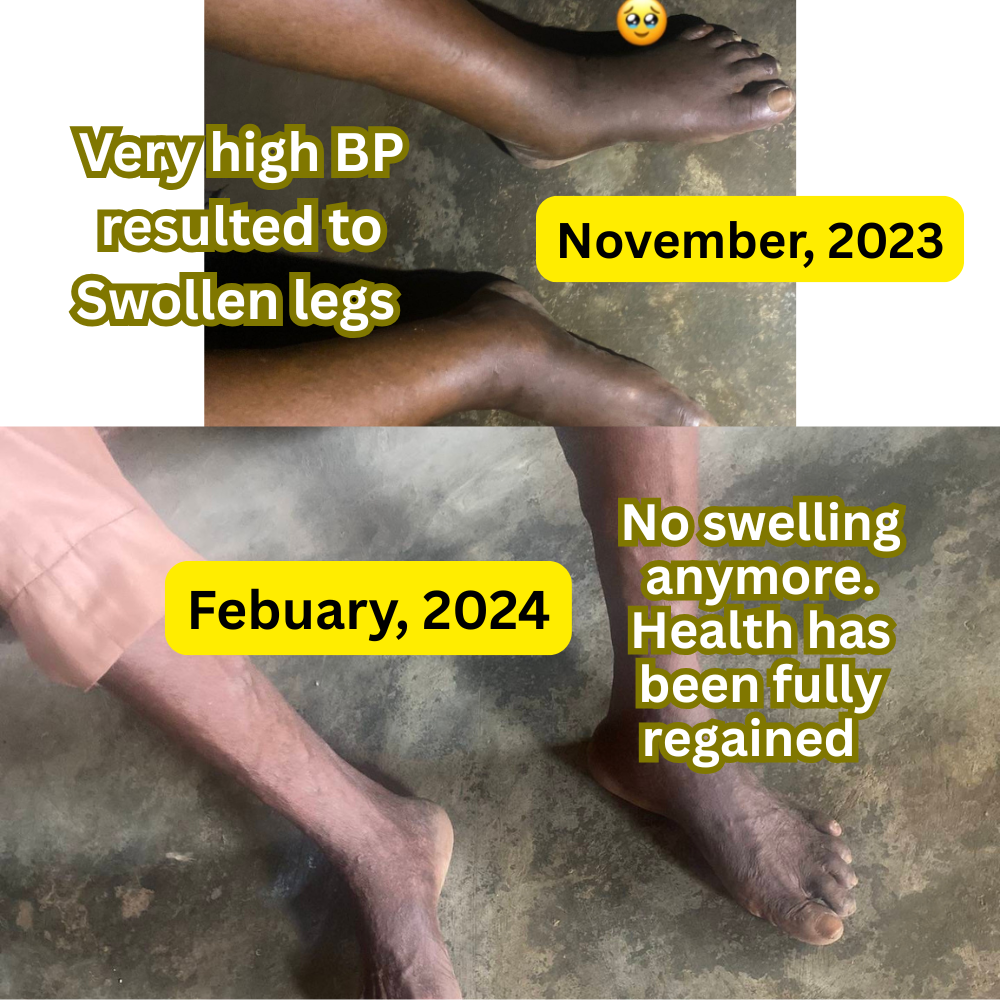 Leg swelling